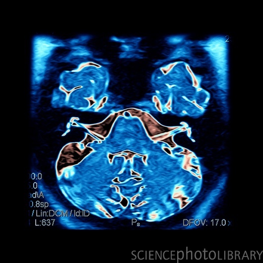 This colour enhanced axial cross sectional MRI image beautifully demonstrates the 7th and 8th cranial nerve complexes within the internal auditory canals (IAC). This MRI sequence is called a CISS sequence and is a highly specialized sequence to look at these nerves when people have complaints of hearing loss. Sometimes hearing loss is the result of a tumor involving the 8th nerve in the internal auditory canal which is called a vestibular schwannoma or acoustic neuroma. MRI is the best method to diagnose this problem.  Living Art Enterprises, LLC/ Science Photo Library